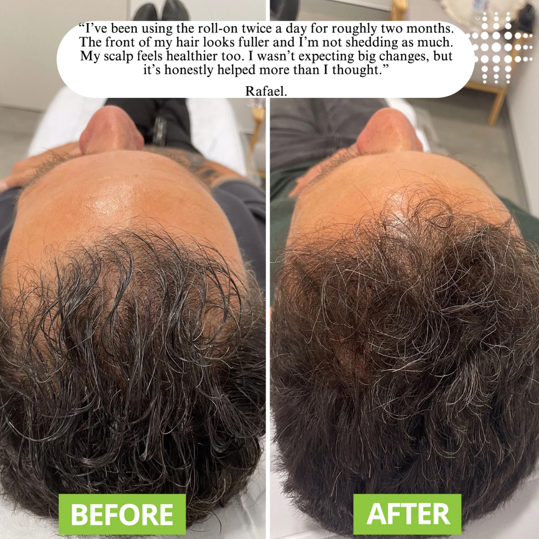 GrowEase™ | Hair Growth Serum Roll-on