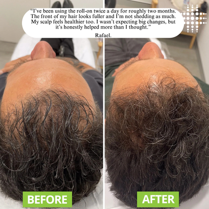 GrowEase™ | Hair Growth Serum Roll-on