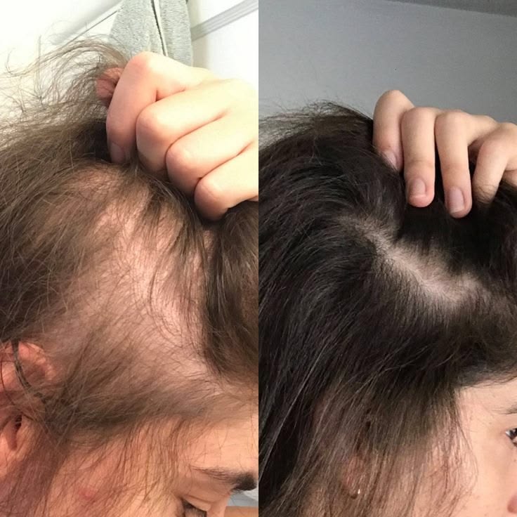 Gleama | DR2 scalp treatment