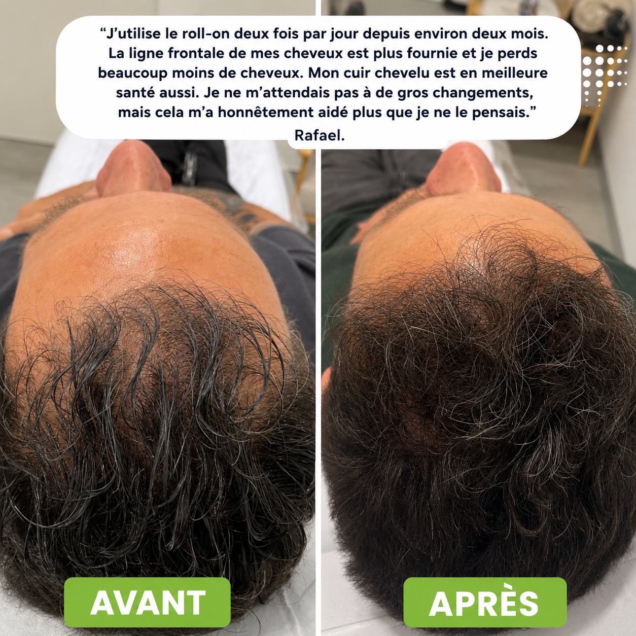 Regenx™ | Haarwuchsserum Roll-on