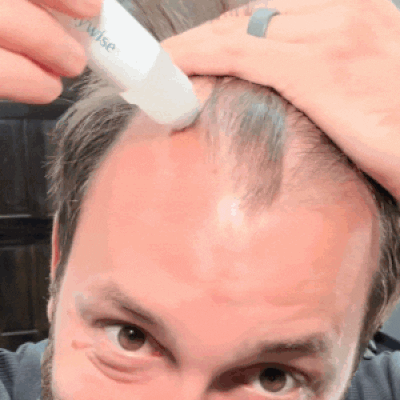 Applying a precision hair roll-on to a thinning area